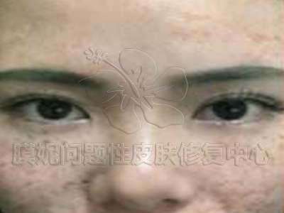 黑痣