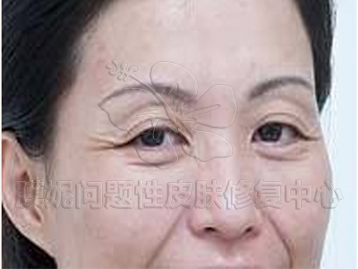 抗皺