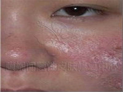 激素臉