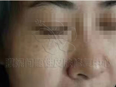 美白