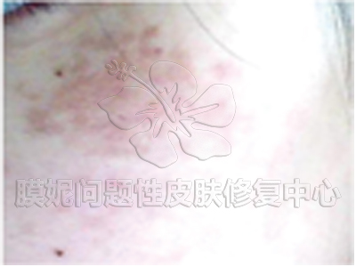 妊辰斑